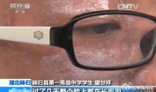 隐翅虫咬人后图片 隐翅虫咬人后图片